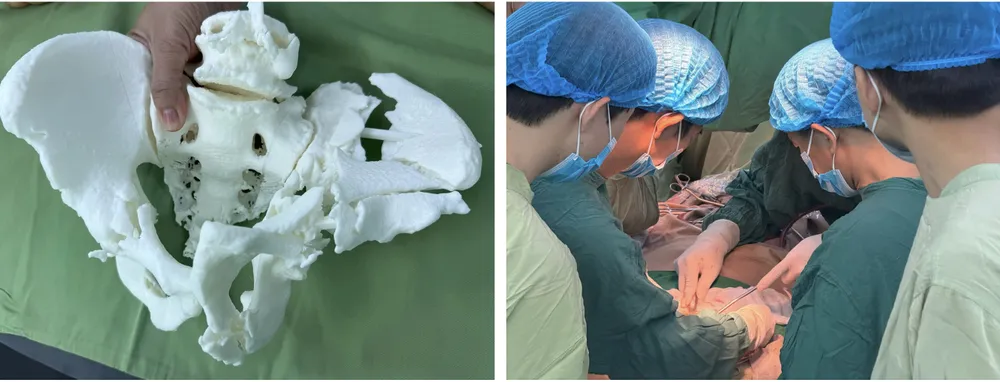Ứng dụng công nghệ in 3D để tái tạo chính xác cấu trúc khung chậu của người bệnh trước mổ 