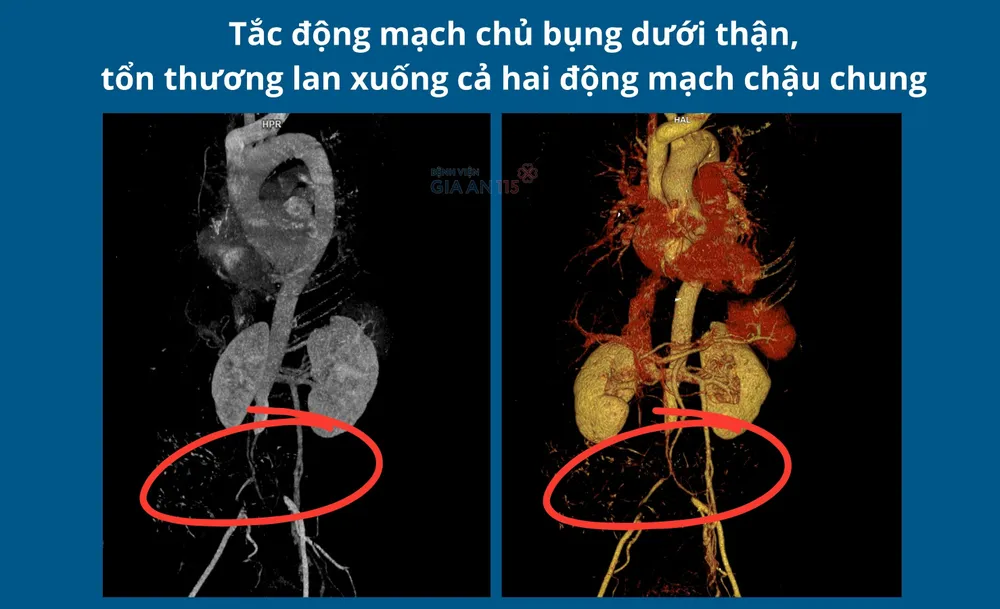 Vị trí tắc động mạch chủ - chậu.jpg