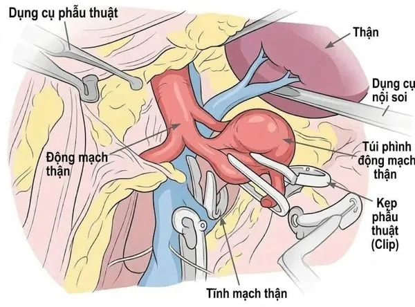 Lược đồ minh hoạ phẫu thuật nội soi kẹp túi phình động mạch thận (Ảnh: BVCC)