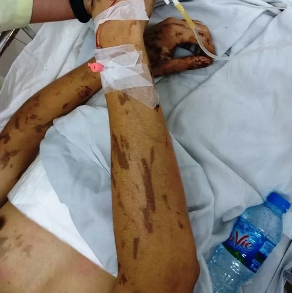 Truy tìm 2 đối tượng tạt axít vào cặp đôi Việt kiều Canada ảnh 1