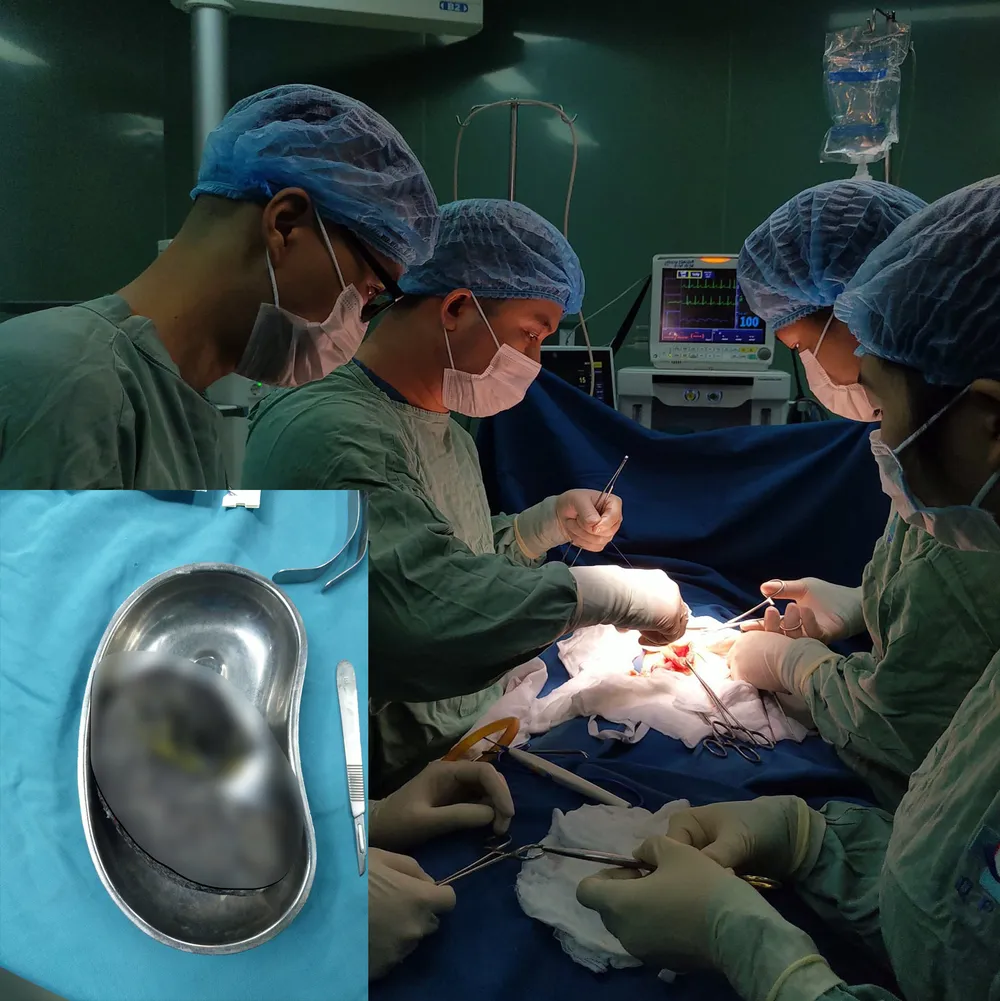 Phẫu thuật lấy gần nửa ký tóc trong dạ dày bệnh nhi 7 tuổi ảnh 1