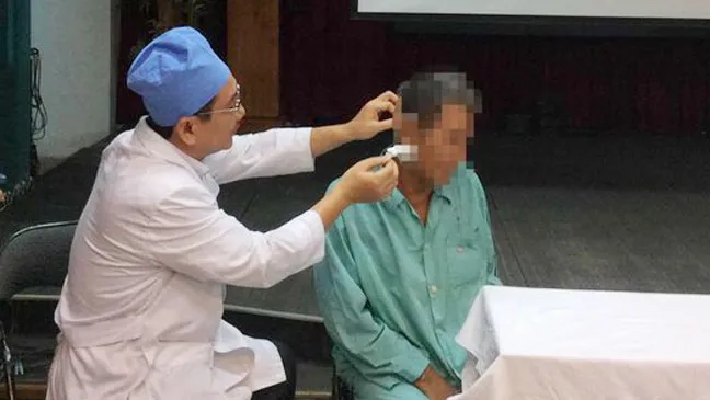 Gắp cây tăm nhang nằm sâu trong lỗ rò luân nhĩ  ảnh 1