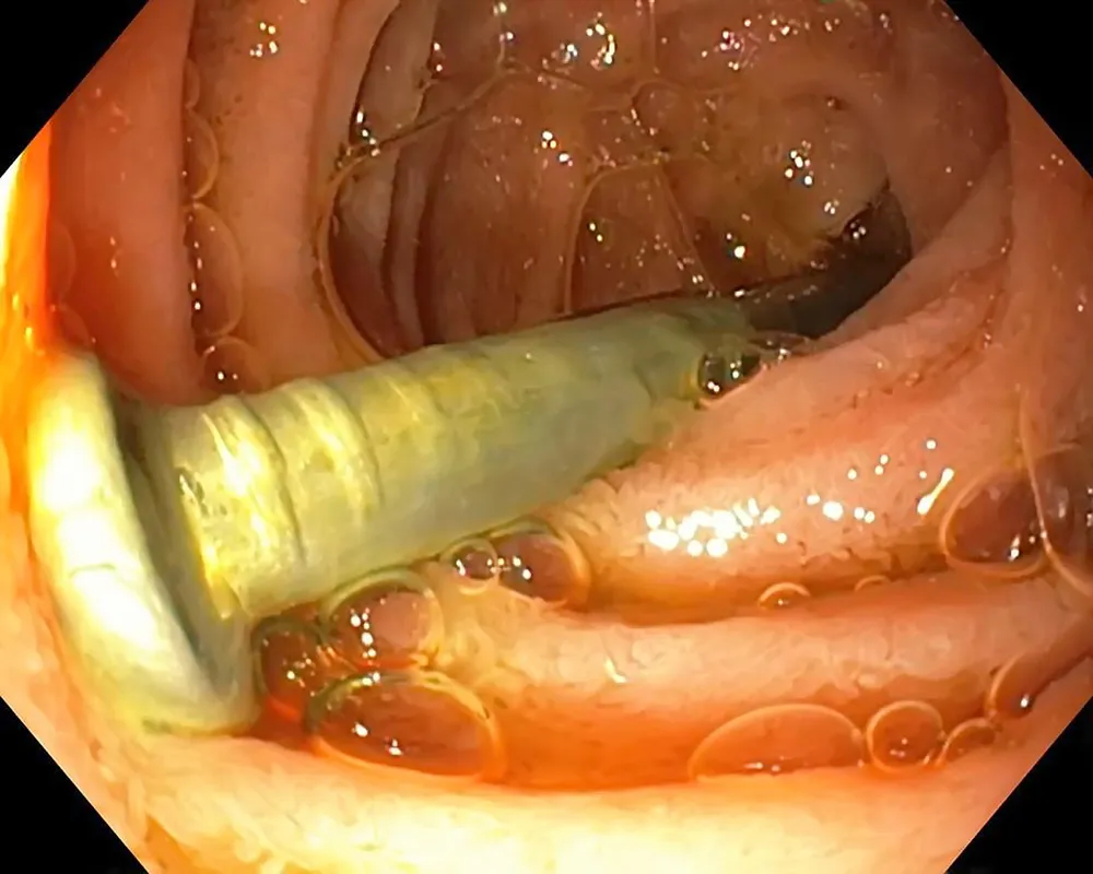 Bé trai 2 tuổi suýt tử vong vì nuốt đinh 3cm ảnh 1