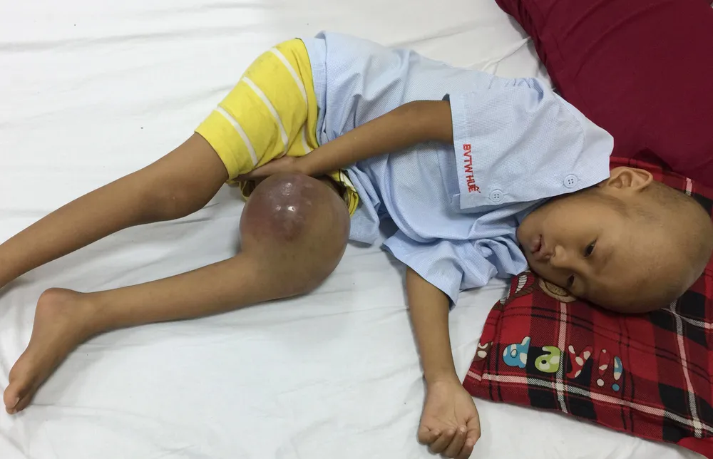 Bé bệnh ung thư cần phẫu thuật ảnh 1