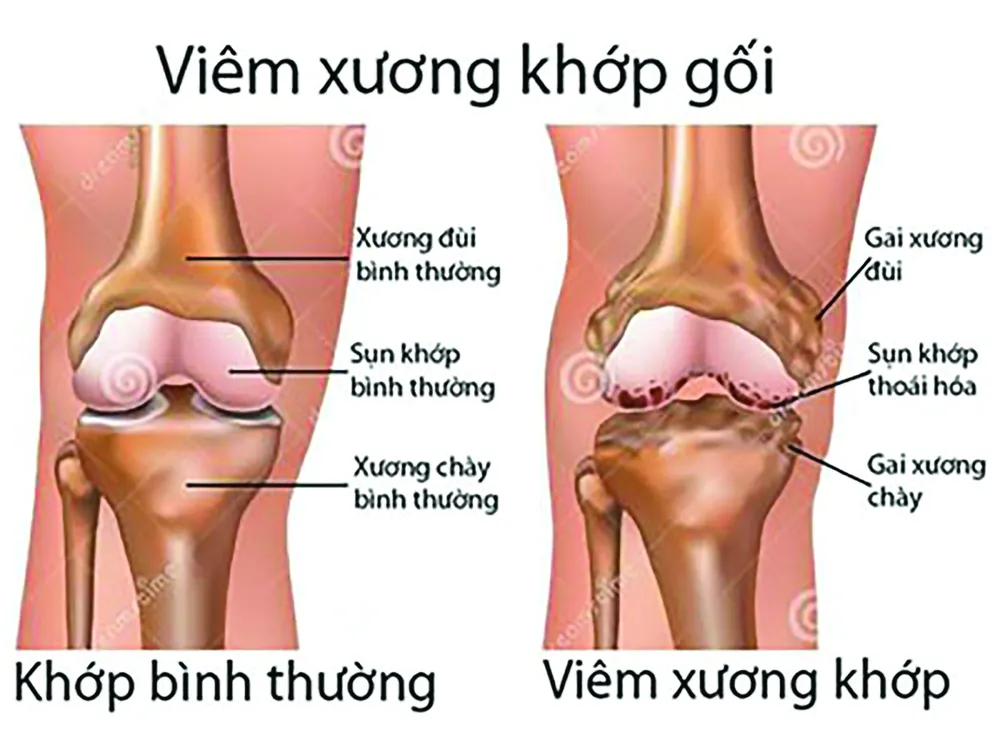 Từ biệt đau đớn do bệnh xương khớp