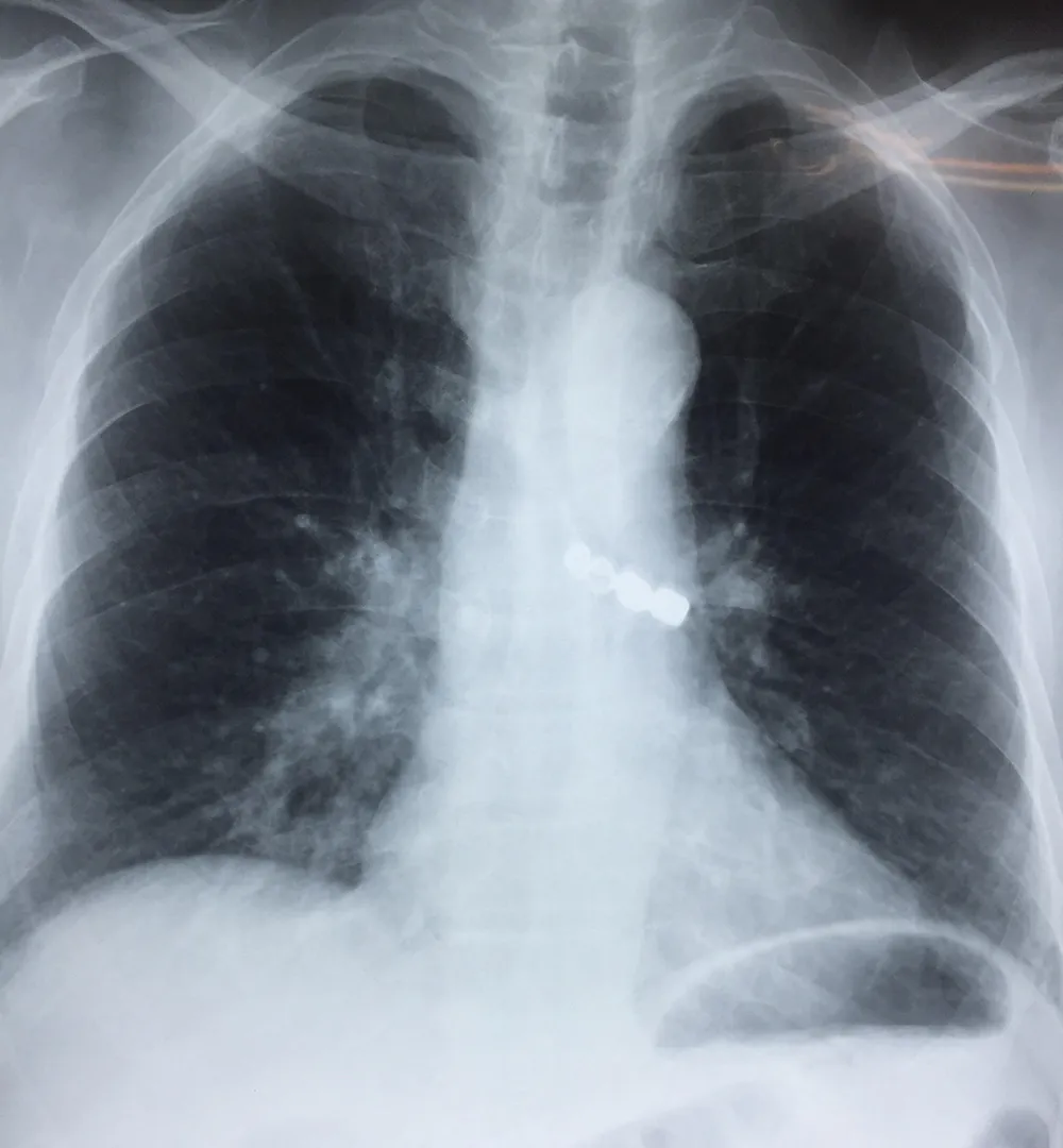 Cứu sống cụ ông 90 tuổi bị rơi cả cầu răng giả 4 chiếc vào phế quản ảnh 1