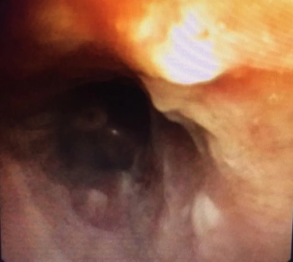 Cứu sống cụ ông 90 tuổi bị rơi cả cầu răng giả 4 chiếc vào phế quản ảnh 2