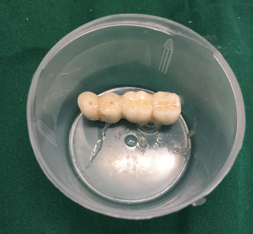 Cứu sống cụ ông 90 tuổi bị rơi cả cầu răng giả 4 chiếc vào phế quản ảnh 3