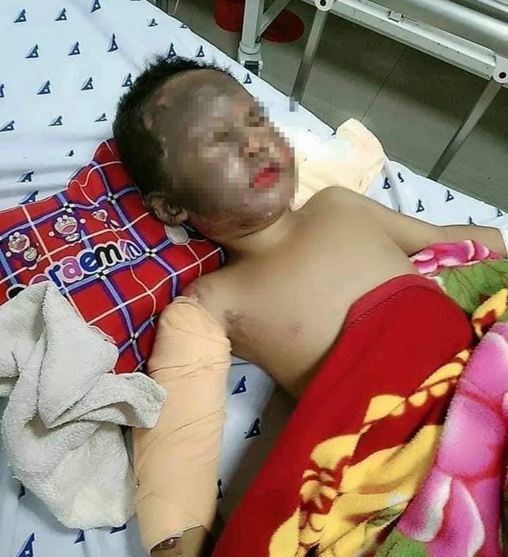 Nghịch xăng, bé trai 4 tuổi bị phỏng nặng ảnh 1