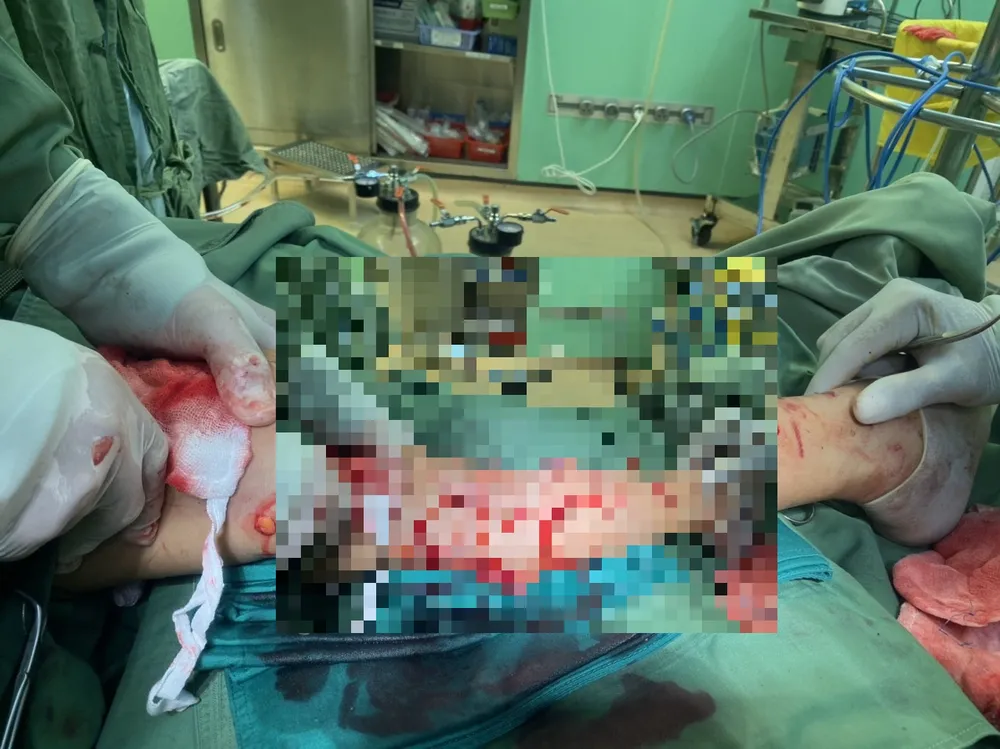 Bệnh viện Bà Rịa mổ cấp cứu 1 trường hợp bị chó cắn dẫn đến đa vết thương