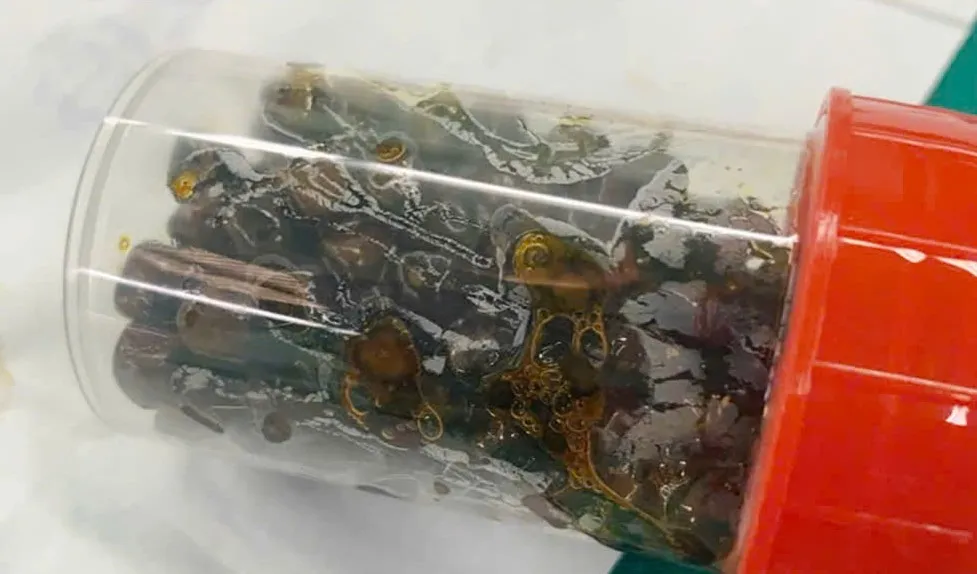 Bệnh viện Đại học Y dược Shing Mark mổ nội soi lấy hơn 100 viên sỏi trong túi mật của một bệnh nhân nữ