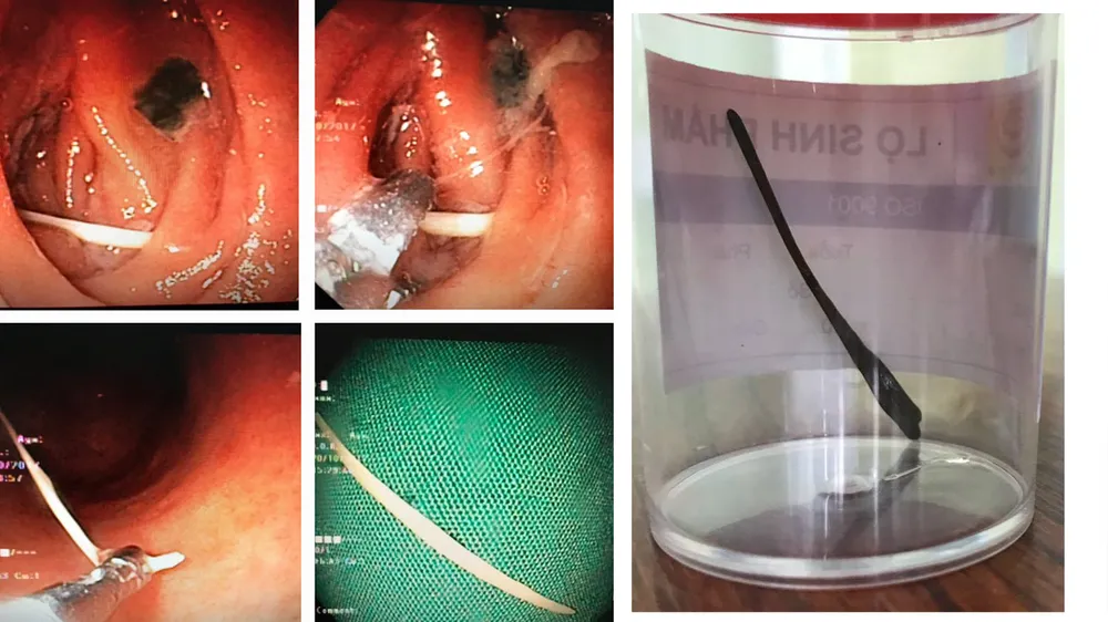 Tăm tre được  nội soi cấp cứu gắp ra ngoài kịp thời