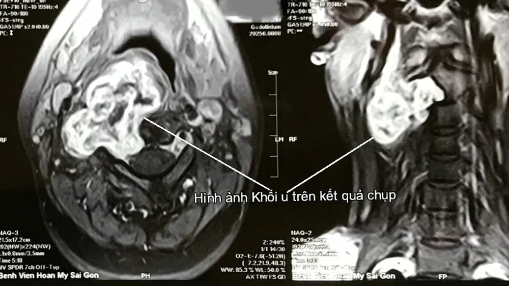 Giúp bệnh nhân bỏ u bao dây thần kinh cột sống cổ xâm lấn  ảnh 1