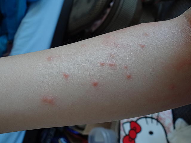 若不慎被昆蟲叮咬後可患上蟲咬性皮炎。（示意圖源：互聯網）
