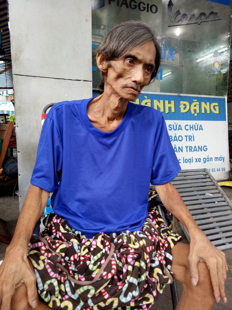 馬少雄肚子脹大，全身消瘦。