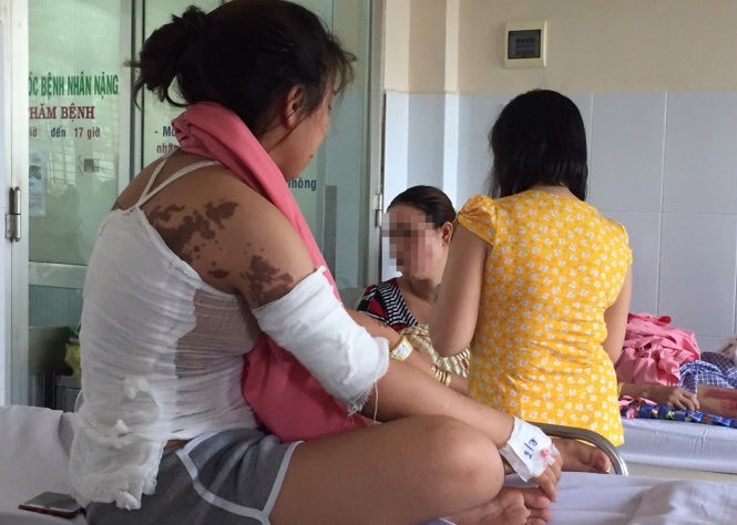 妙齡女子被潑硫酸燒傷整張背和手臂。