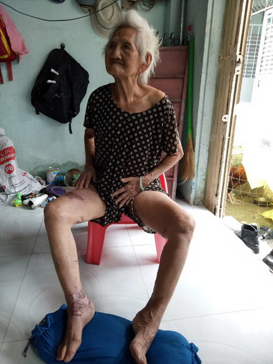 劉大娘被燒傷後無法行動。