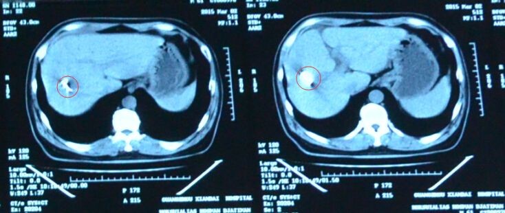 125I 粒子植入術定向爆破惡性腫瘤 ảnh 1