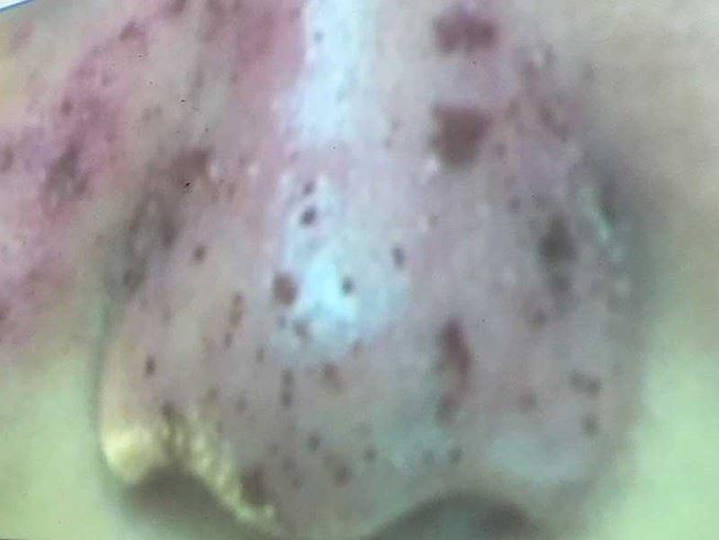 注射來歷不明玻尿酸引致鼻部的皮膚幾乎壞死。