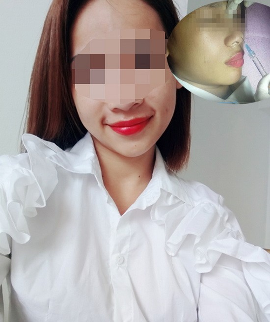 少女注射填充劑隆鼻後，導致單眼失明。（圖源：當事人提供）