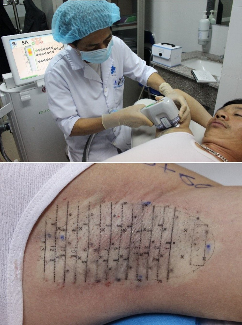 治療腋臭症不需動手術。（圖源：中央皮膚病醫院整形手術科）