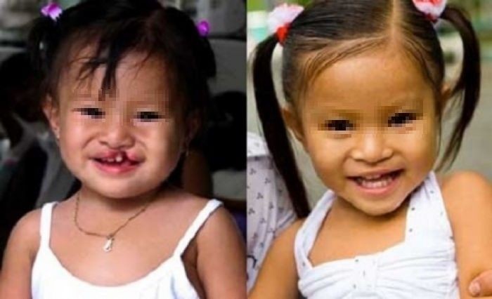 一名唇顎裂女童接受唇顎裂修補手術前後。（示意圖源：市醫藥大學）