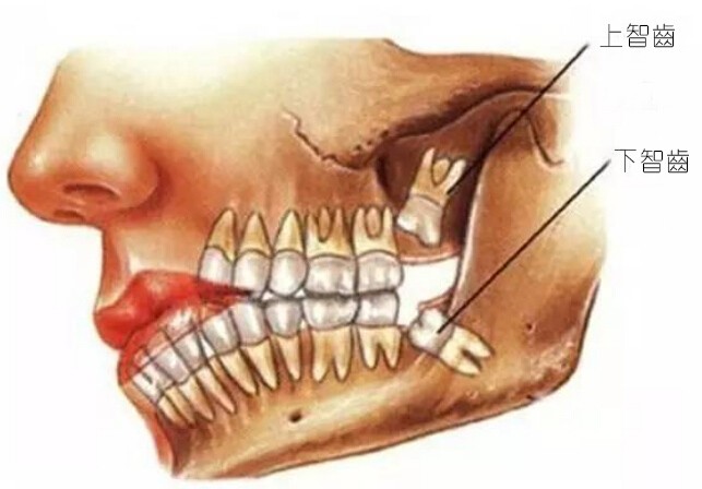 什麼樣的智齒必須拔掉。（示意圖源：互聯網）