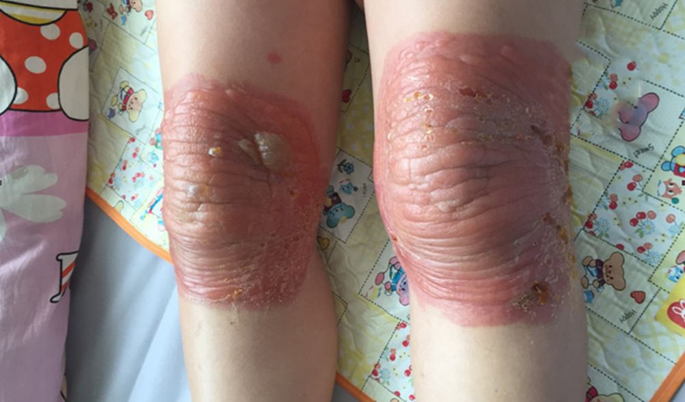 聽從熟人的指引，T女士到一家東藥店治療膝關節疼痛。敷藥３天後，她發高燒和膝蓋嚴重灼傷。