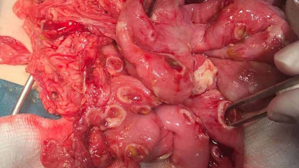 約30釐米長的腸道出現直徑0.5至1釐米的50個破洞。（圖源：秋香）