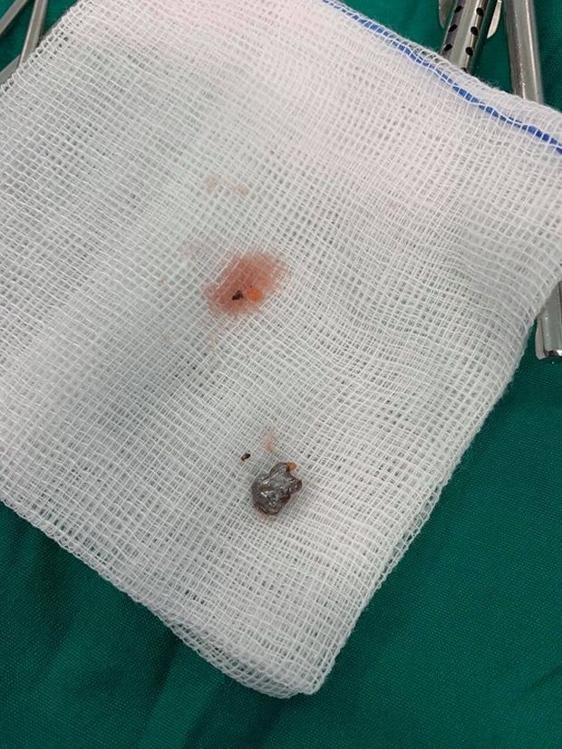 內窺鏡手術為男童取出子彈 ảnh 1