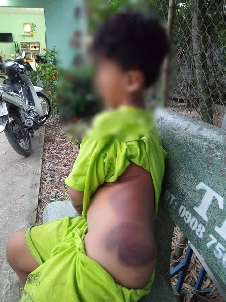 遭班主任罰打屁股到瘀傷的一年級小學生。（圖源：互聯網）