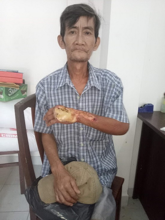 陳國峰的手又腫又腐爛。