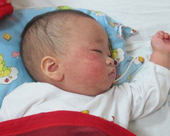 市衛生防疫中心：年初 60 幼兒罹患麻疹病。（示意圖源：互聯網）