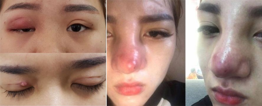 希望擁有更美的外貌，許多整容者遭遇後遺症。