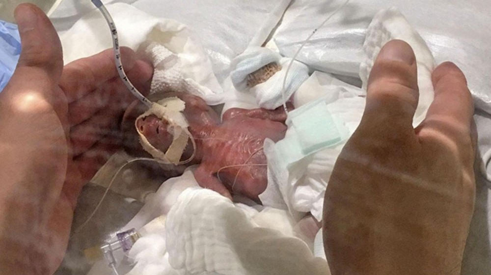 世界最小男嬰已健康出院。圖為出生時僅重 268 克的世界最小男嬰。（圖源：共同社）