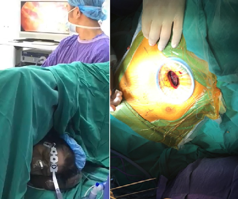 越德醫院成功應用非氣管插管全身麻醉及單孔胸腔內窺手術等新技術為患者割除肺腫瘤。（圖源：黎石）