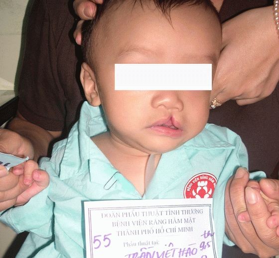 獲免費治療的一名兔唇少兒。（圖源：市口腔頷面醫院）