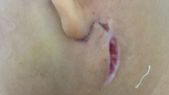 當前入住乂安省產育醫院接受治療中的其中一名病童的傷口。