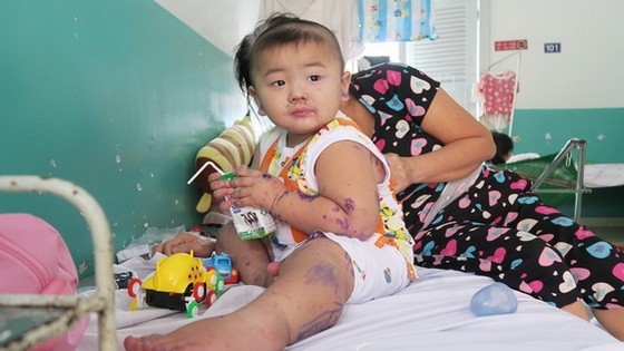 入住市第二兒童醫院接受治療中的一名病童。（圖源：丁姮）