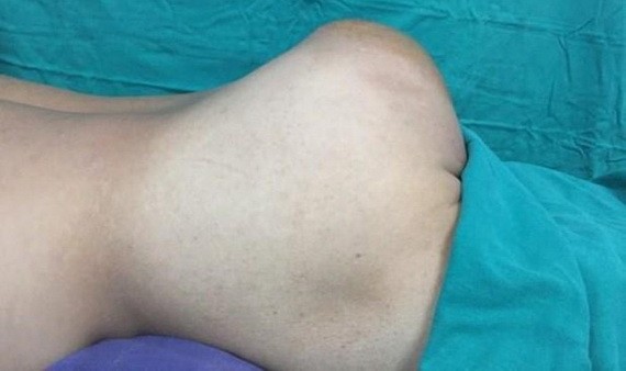 患者手術前的情況。（圖源：越通社）