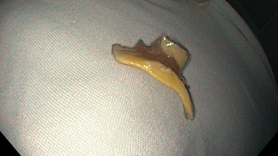 醫生採用內窺鏡技術從患者胃部取出的假牙。（圖源：嘉欣）