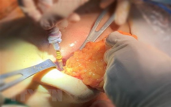 JW美容醫院醫護團隊從患者的右胸中取出矽膠塊。