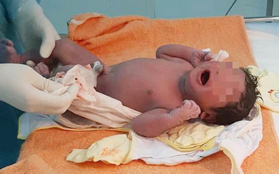 經過40分鐘剖腹手術一名3公斤重的男嬰順利問世。（圖源：院方提供）