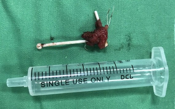 經手術取出體外的T型節育環。（圖源：院方提供）