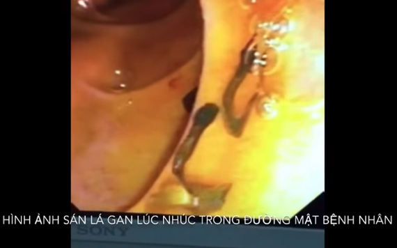 內窺鏡探查結果顯示，患者膽管內顯現許多在移動的肝吸蟲。（圖源：院方提供）