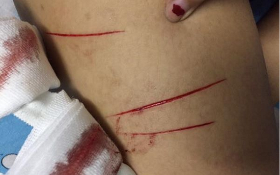 女生腿部被劃傷的傷勢。（圖源：何莊）