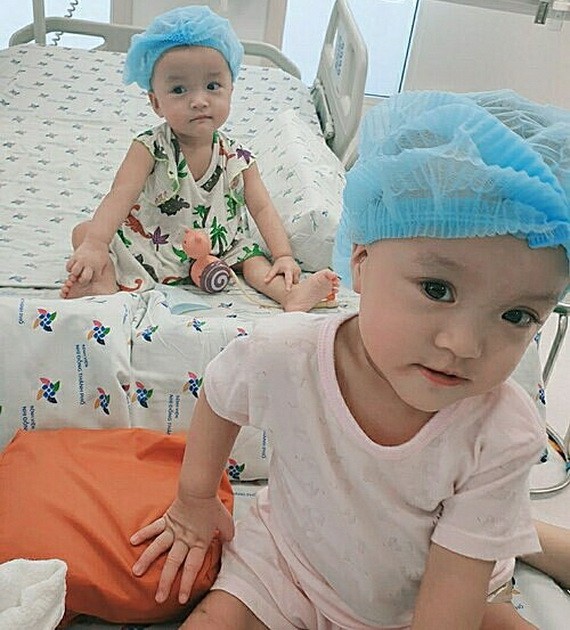 連體女嬰竹兒-妙兒成功分離一個多月後健康良好。（圖源：院方提供）