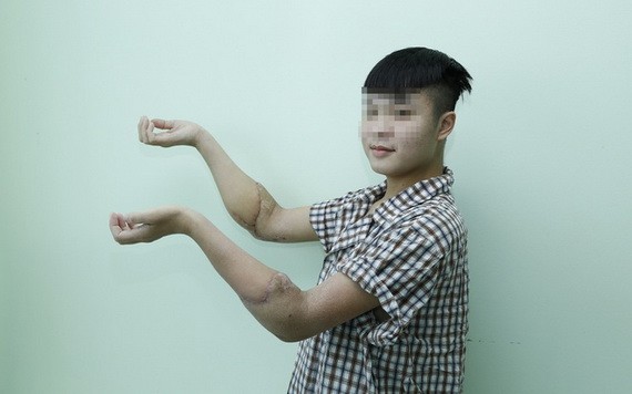 圖為一名接受雙手前臂移植手術後的年輕受贈者。（圖源：院方提供）