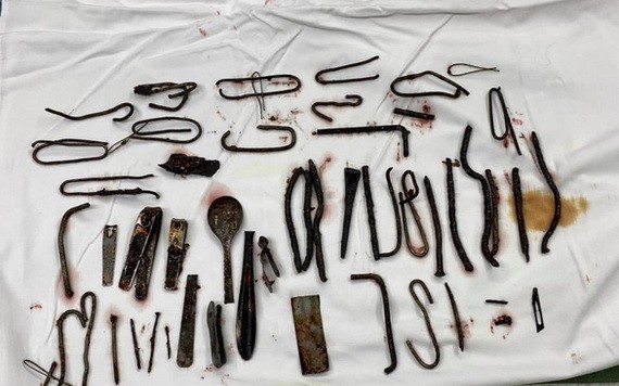 經手術從患者胃部取出體外的大量金屬異物。（圖源：院方提供）