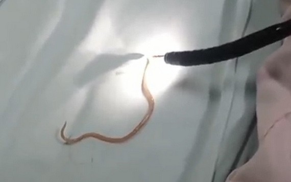 經內窺鏡手術從病童的胰管中取出一條活著長約15釐米的蛔蟲。（圖源：院方提供）